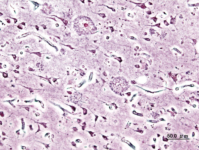  plaques and neurofibrillary tangles.