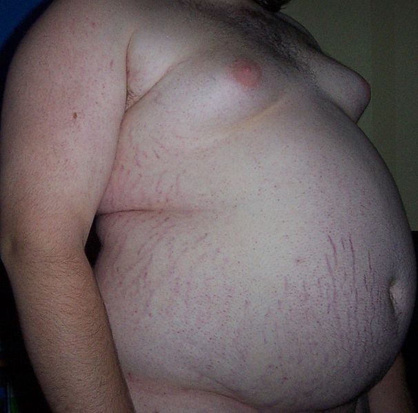 An Obese Teenager with Central Obesity, side view