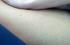 A picture to illustrate pigmentation of human skin.