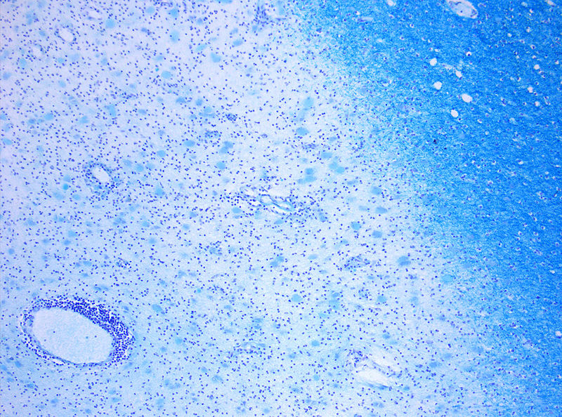 Photomicrograph of a demyelinating MS-Lesion.