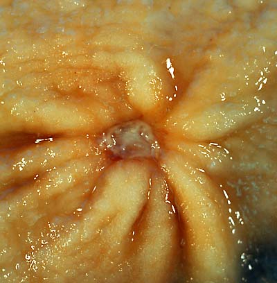 Gastric Ulcer