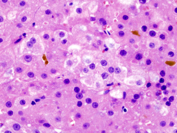 Histopatholgical image of hepatocellular carcinoma 
