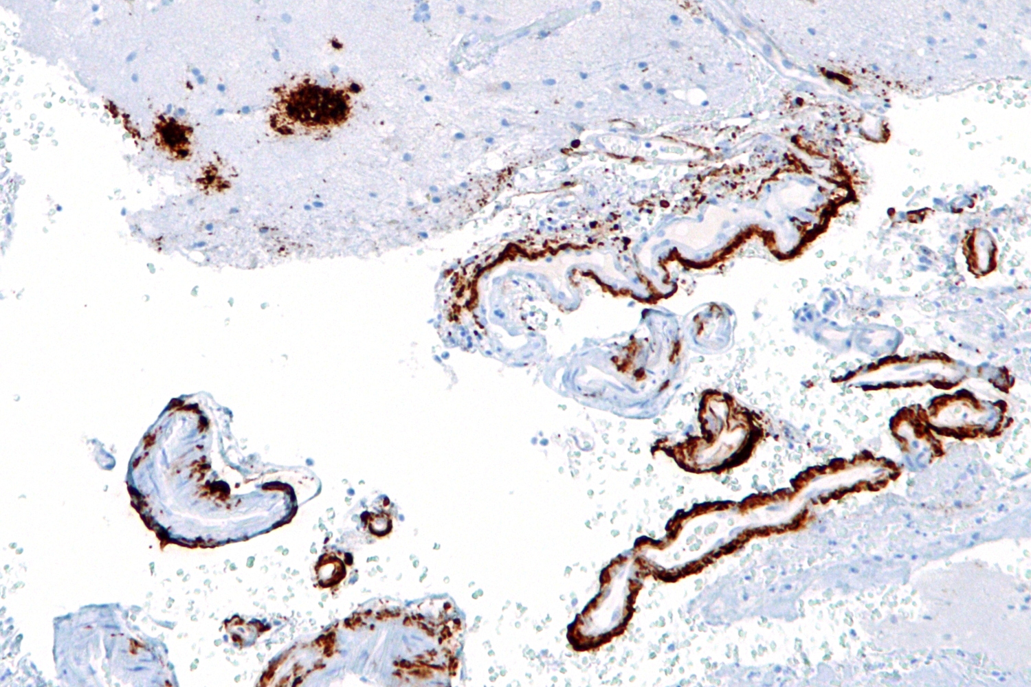 Amyloid beta plaques