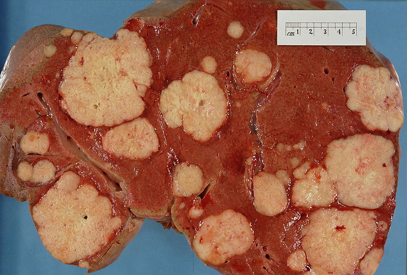 Secondary tumor deposits in the liver from a primary cancer of the pancreas