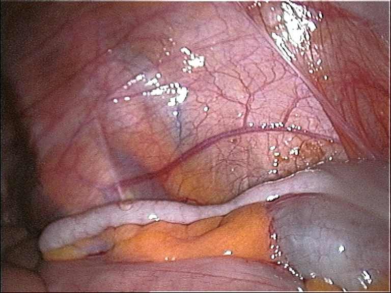 vermiform appendix