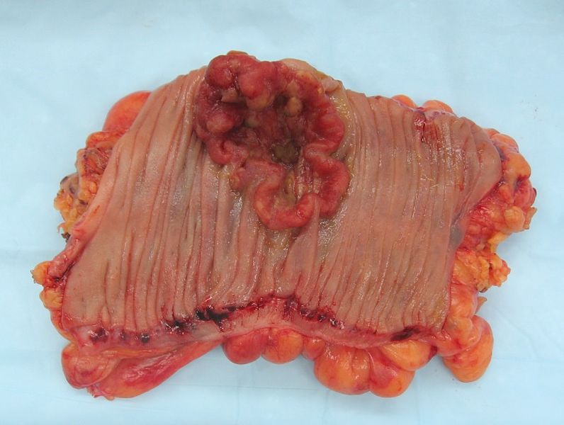 Colorectal cancer, gross appearance of an opened colectomy specimen