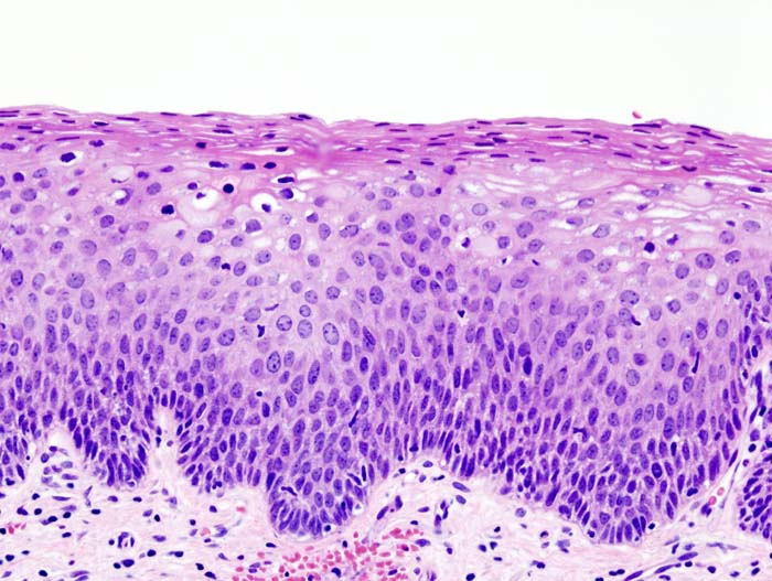 Cervical cancer Intraepithelial neoplasia