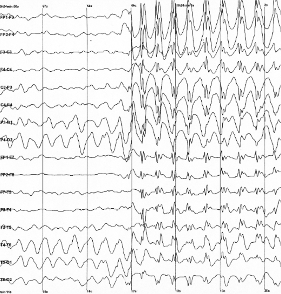 EEG - Generalized 3 Hz spike and wave discharges in a child with childhood absence epilepsy