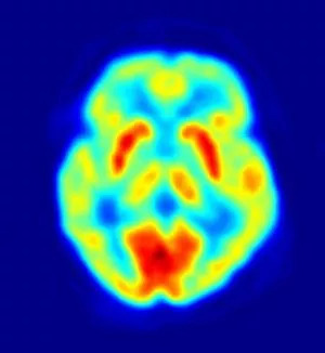 PET Image of the human brain showing energy consumption