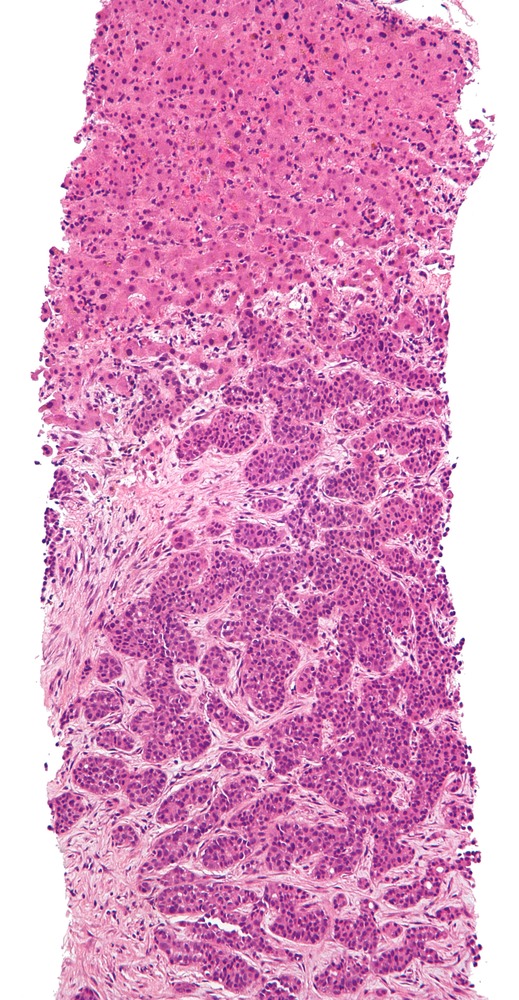 Low magnification micrograph of a metastatic adenocarcinoma to the liver. Liver biopsy. H&E stain.