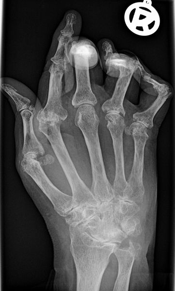 Rheumatoid Arthritis x-ray