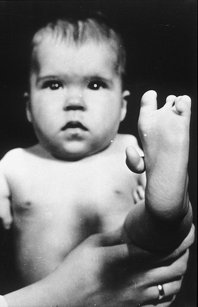 Thalidomide Deformed baby