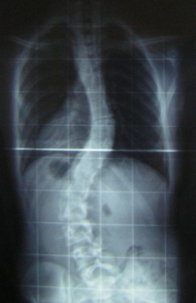 An X-ray of the spine of a patient with scoliosis