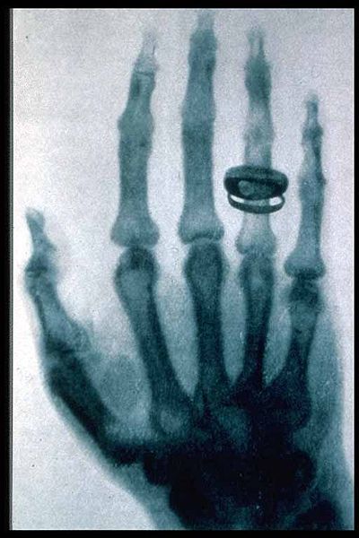 Roentgen's X-ray picture of the hand of Alfred von Kolliker, taken 23 January 1896