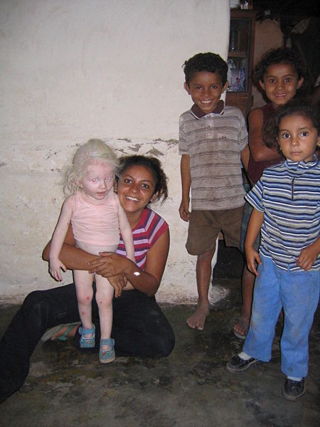 A albino girl in Honduras.