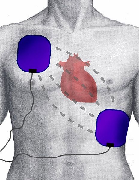 cardiac defribrillator