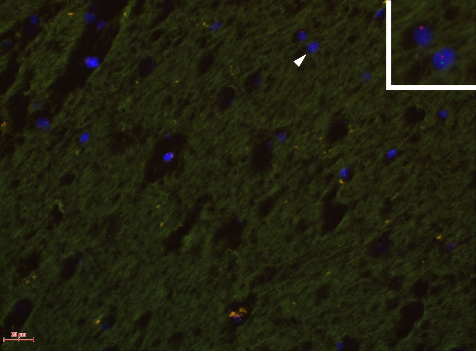 This shows a male cell in female human brain.