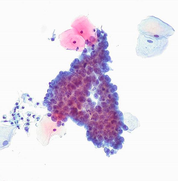 Cytological specimen (ThinPrep) from a patient who was later diagnosed with cervical adenocarcinoma in situ.