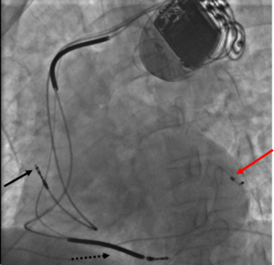 Pacemaker