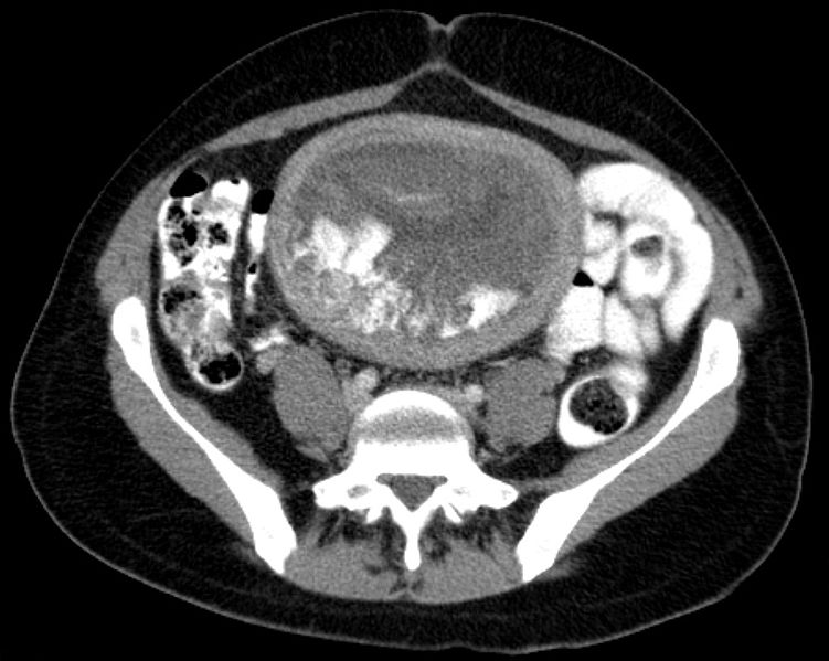 Hydatidiform mole on CT, axial view