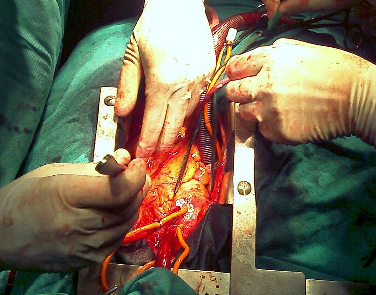 Human heart seen in a cardiac surgery operating room