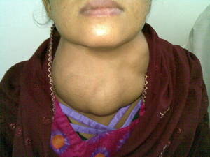 Nodular goitre of a young woman