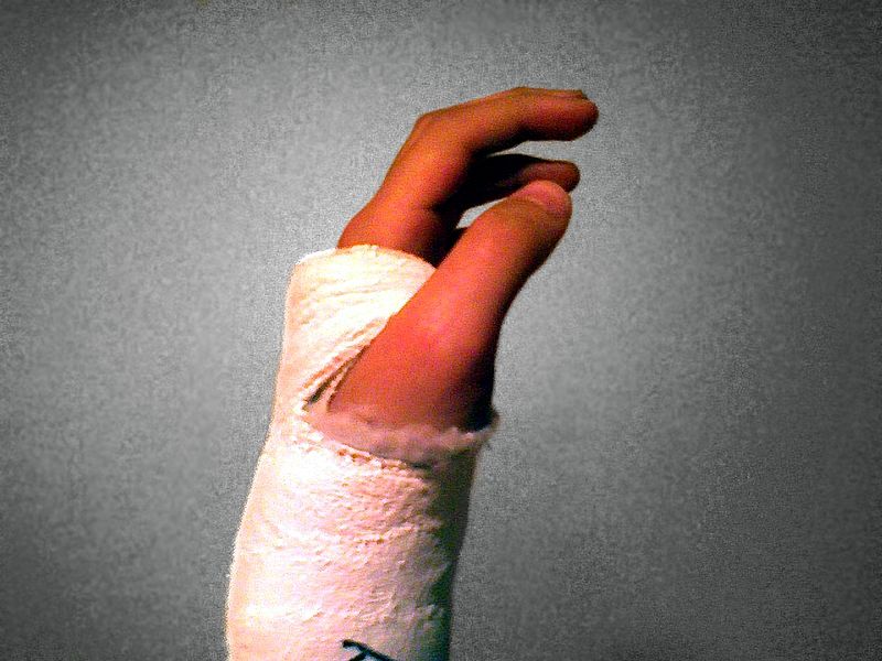 Plaster cast on forearm/wrist/hand.