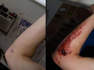 A comparative picture of untreated 7-days-healed road rash in the form of a scar one year later. Fresh wound is on the right, and scar is on the left.