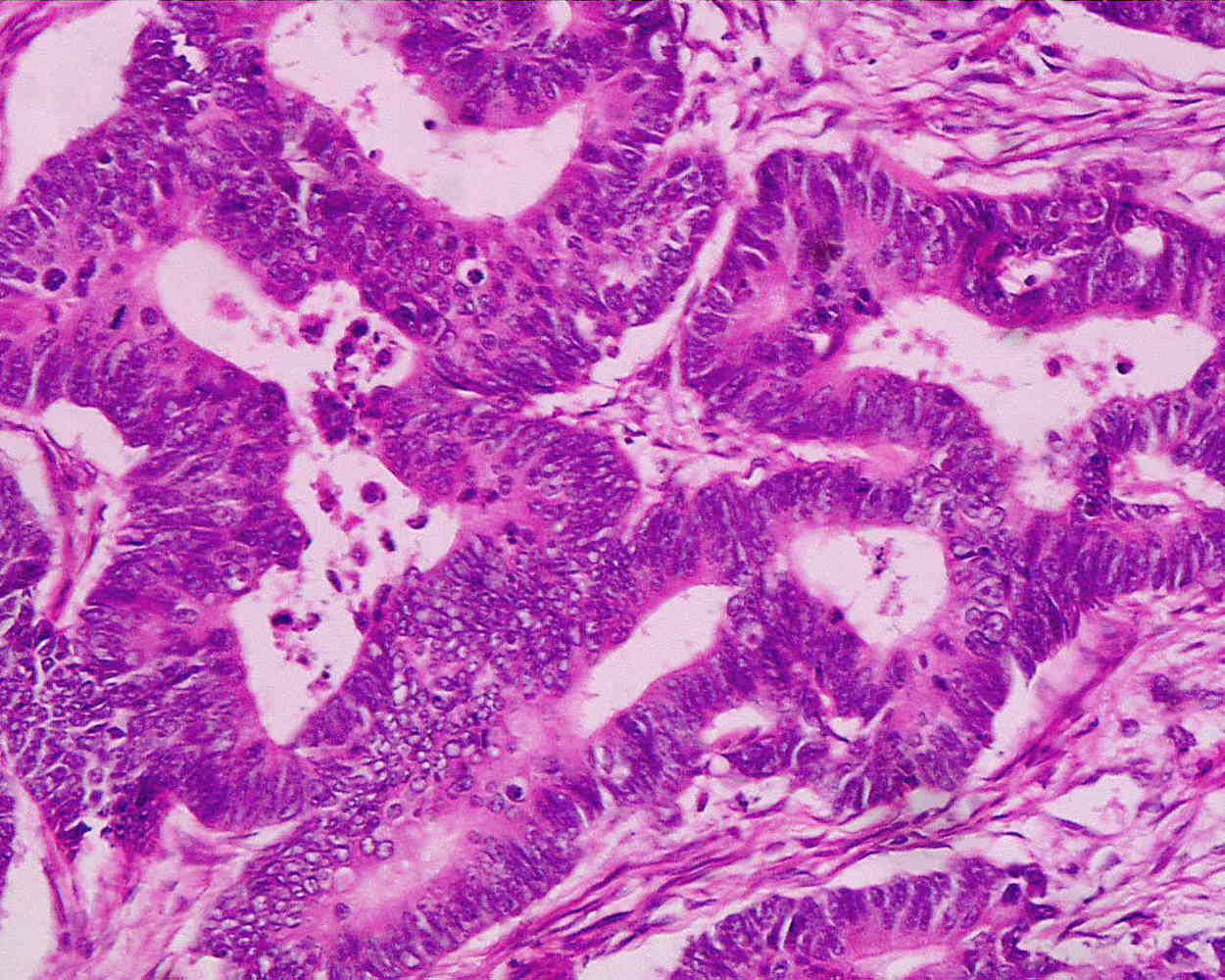 Adenocarcinoma highly diffrerentiaded from the rectum