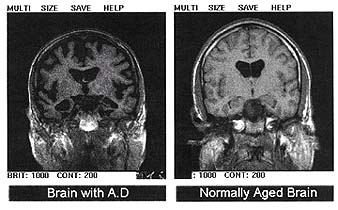 Two transaxial slices through the head. The right image shows a normal brain; the left has differences that are interpreted as indication of Alzheimer's disease