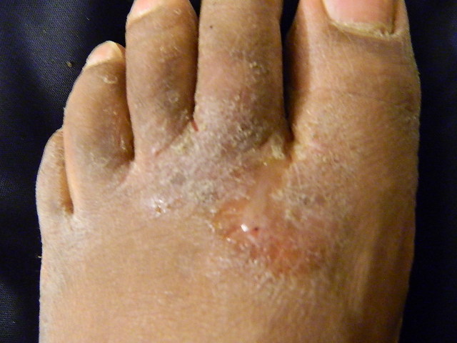 Athlete's foot fungal infection