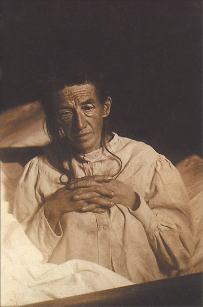 Alois Alzheimer's patient Auguste Deter in 1902. Hers was the first described case of what became known as Alzheimer's disease.