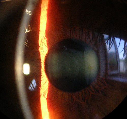 Slit lamp image of cornea, iris and lens.