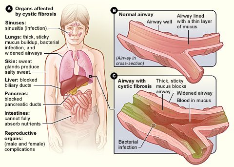 the organs that cystic fibrosis can affect. Figure B shows a cross-section of a normal airway. Figure C shows an airway with cystic fibrosis. The widened airway is blocked by thick, sticky mucus that contains blood and bacteria.