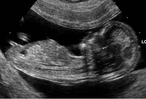 Ultrasound image of an Embryo at 12 weeks