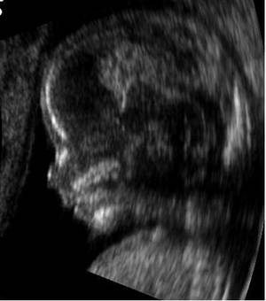 Embryo at 14 weeks (profile)