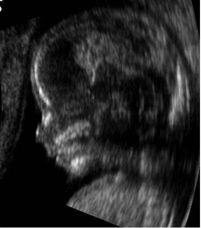 Embryo at 14 weeks