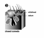 closed comedone - sebum build-up