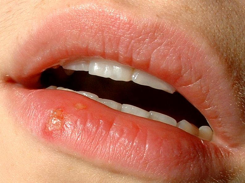 Cold sores - a result of Herpes infection