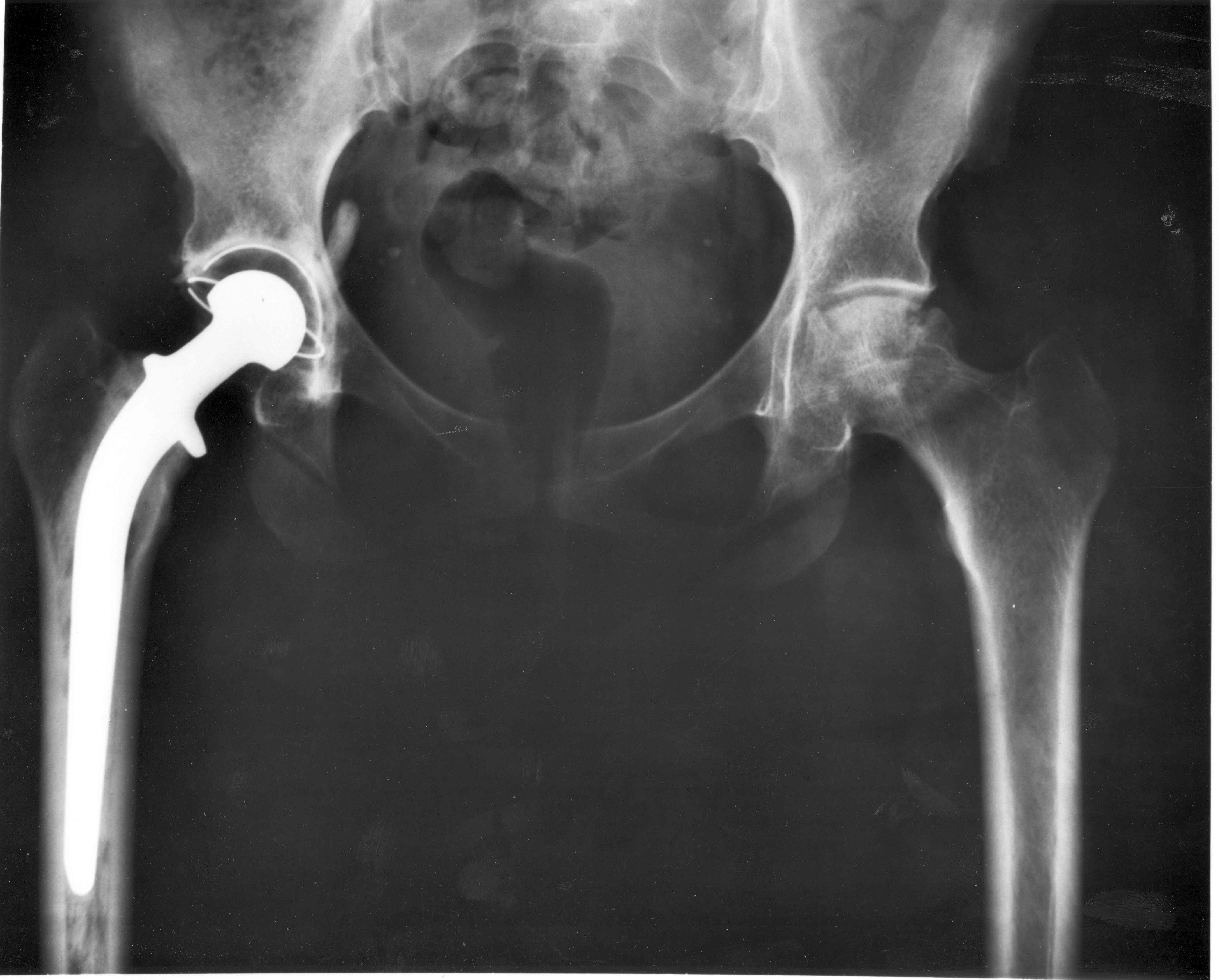 Replacement hip joint