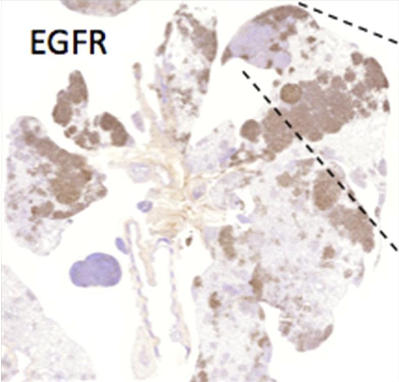  Lung cancer in mice with expression of two different cancer causing mutations. When we actually took the tumours out of these mice later on, and actually looked to see if both these genes were expressed, we found that only one of the two was...