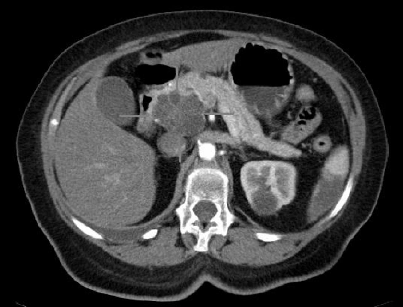 Axial CT image with i.v. contrast. Macrocystic adenocarcinoma of the pancreatic head.