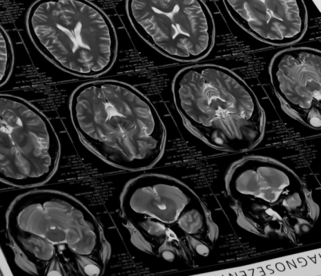 MRI