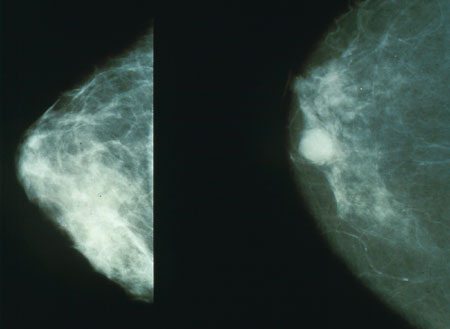 Normal (left) versus cancerous (right) mammography image.