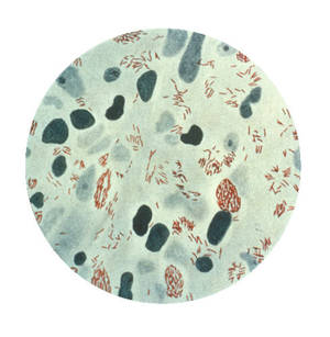 A photomicrograph of Mycobacterium leprae taken from a leprosy skin lesion