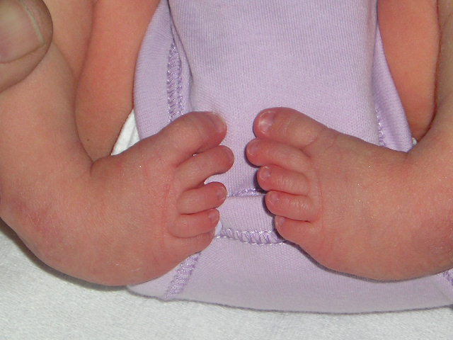 A child with club foot