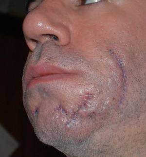 Acne Scars after revision