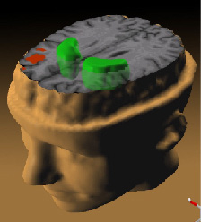 A PET scan, illustrating of Schizophrenia's effect on the brain