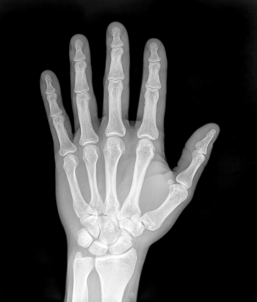 X ray of hand