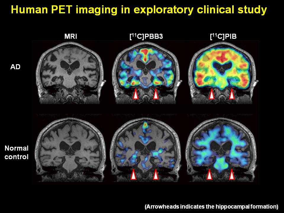 Alzheimer's brain